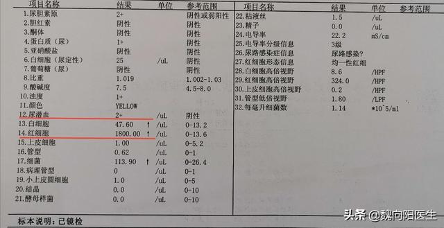 反复无痛性肉眼尿血警惕膀胱癌。