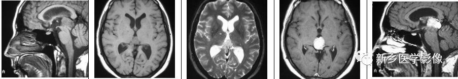 12种松果体区肿瘤的影像表现