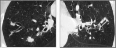 一文总结囊性纤维化的肺部影像学特征｜相“影”成趣