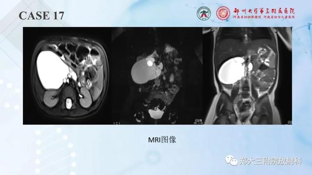 儿童腹部囊性病变诊断思路分析