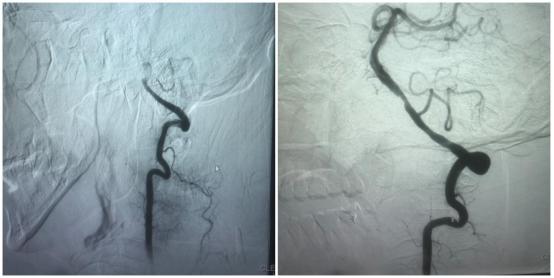 老李|“头晕”别大意，背后的健康杀手有可能是脑梗死