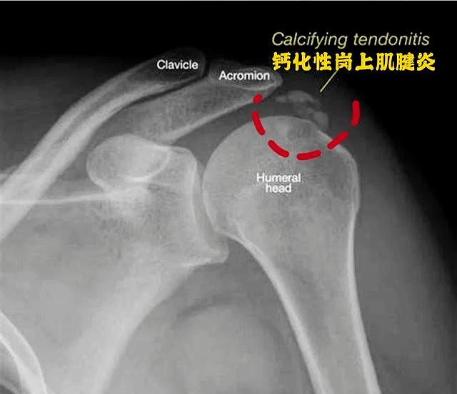 长期肩膀疼痛，反复治疗也不好，问题在哪儿？医生帮您分析下！