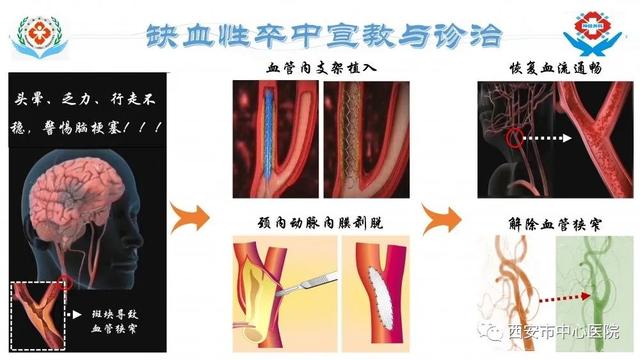 我明明得的是房颤，为什么又脑梗死了？