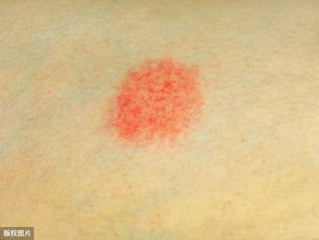 重申:身上有红痣,需警惕蜘蛛痣!可能是肝癌的信号