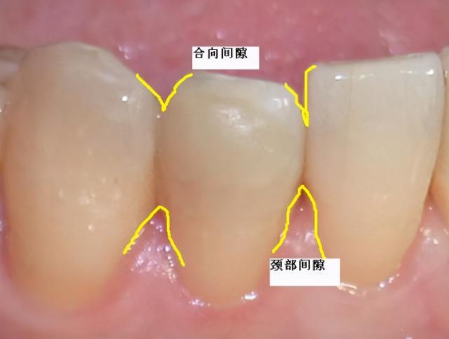 牙齿出现黑三角怎么办？真的是不可逆的吗？听听看牙医怎么说