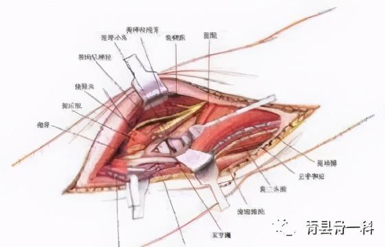 肌腱断裂是啥病？都有哪些危害呢？