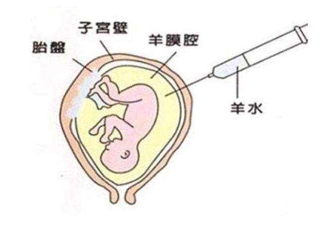 「你的育儿经」这4类孕妈易怀唐氏儿，唐筛并不完全准确，有2种筛查更准确