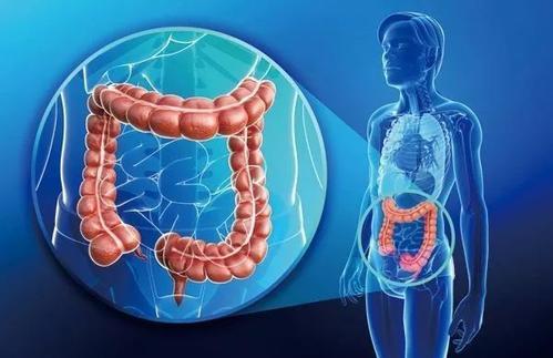 3人相继查出肠癌医大四院专家提示：有肠癌家族史人群患癌风险高