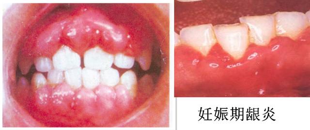 你的育儿经■千万不要带病怀孕！