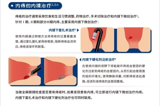 治疗|苏大附一院消化内科开展内镜下内痔微创治疗新技术