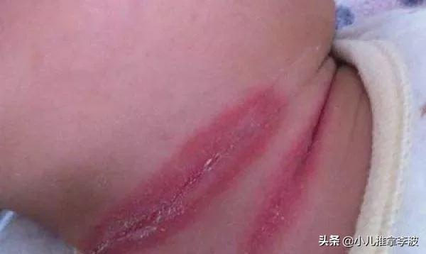 你的育儿经|小儿推拿李波：夏季宝宝淹脖子，发红又破皮怎么办？如何正确护理