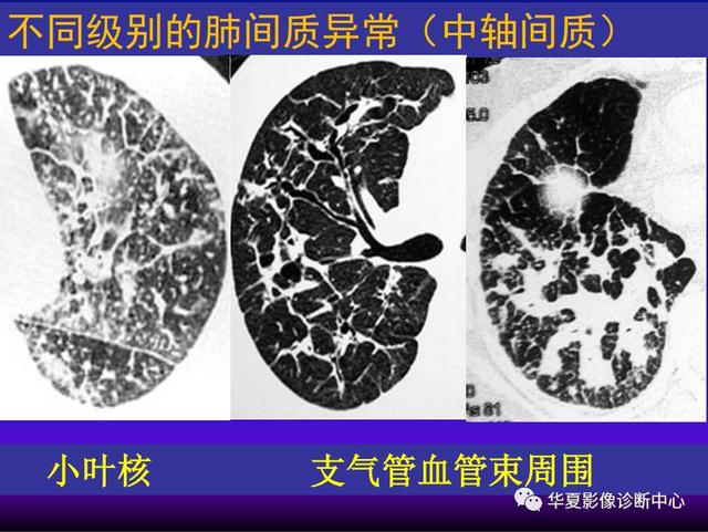 肺间质性疾病的解剖、病理、影像分析