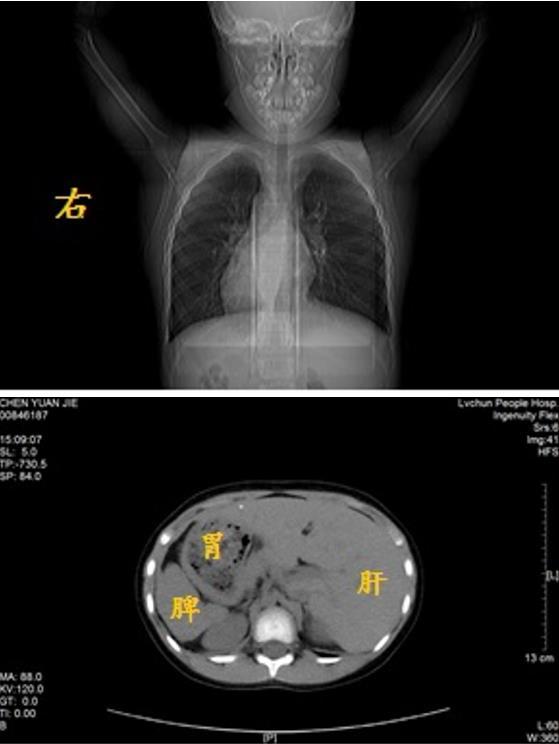 小杰|7岁哈尼族“镜面人”获救！复旦儿科完成云南绿春首例“镜面人”诊治