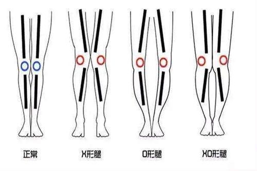 O型腿除了不好看还易患「膝骨关节炎」，难上加难如何才能避免？