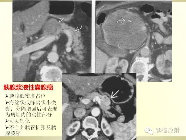 胰腺CT增强扫描、血管评价及病变诊断