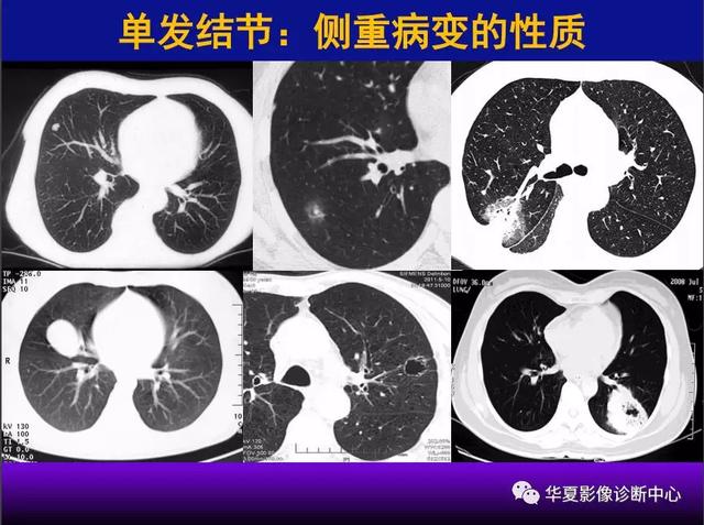 肺间质性疾病的解剖、病理、影像分析