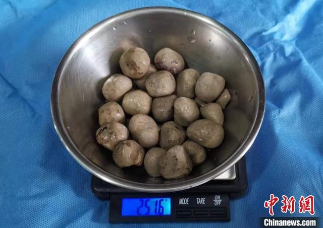 膀胱|八旬老人体内取出半斤“鸽子蛋”专家：前列腺癌需及早治疗