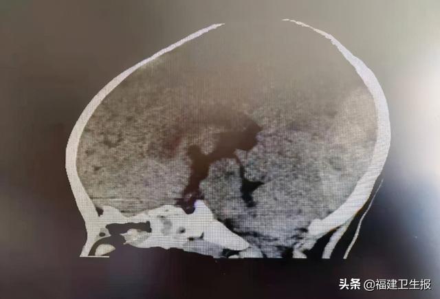 出血|厦门1岁宝宝在家摔倒，颅内巨大血肿全然不知！孩子磕碰摔伤，这些紧急处理千万别做错