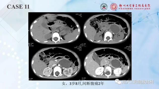 儿童腹部囊性病变诊断思路分析