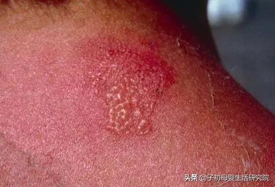 「超级宝妈」宝宝晒伤了?比你想象中还要可怕