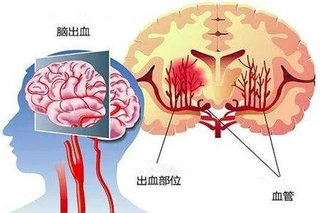 台州文化生活频道丨高血压脑出血后的病人不这样处理，后果不堪设想