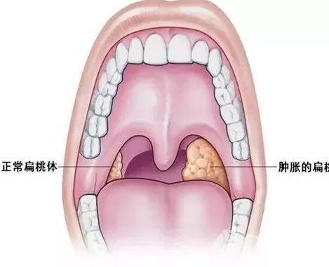 难道想要摆脱扁桃腺反复发炎的困扰，一定要切除扁桃腺不可吗？