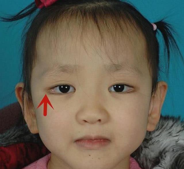 [你的育儿经]太漂亮也不好？宝宝天生自带“眼妆”，竟是一种罕见病？