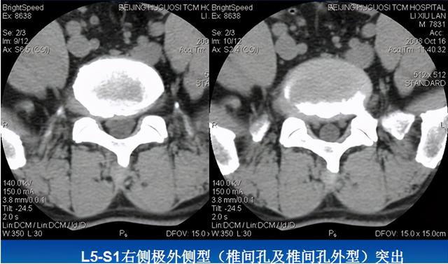 腰椎间盘CT诊断：椎间盘膨出、突出、椎管狭窄及退行性病变