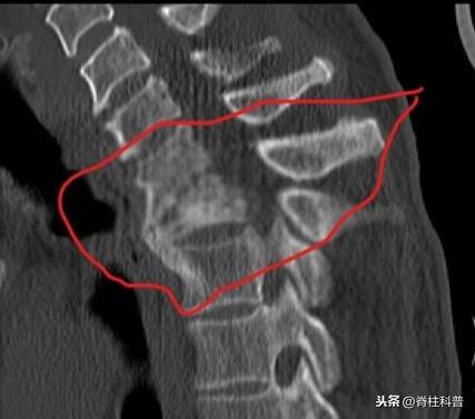 世界防治结核病日，不止重视肺结核，脊柱结核更是重点！