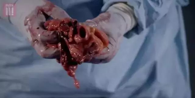 体重|一半国人超重！看完胖子的解剖内脏，只想减肥！