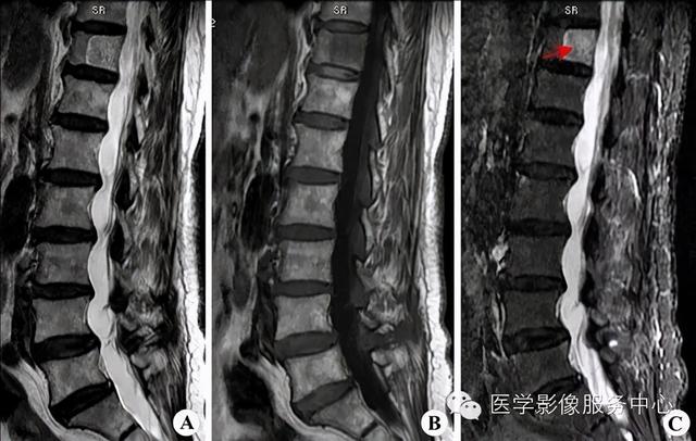 77种骨肌影像病例，助你诊断无忧