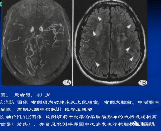 烟雾病的CT及MRI诊断