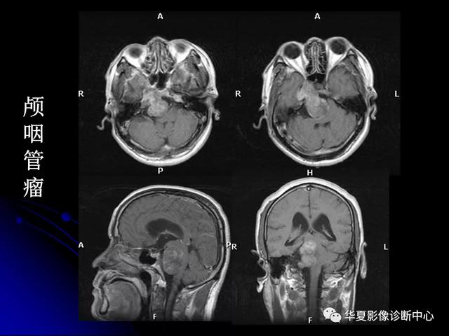 「影像复习」脑干区常见病变影像表现