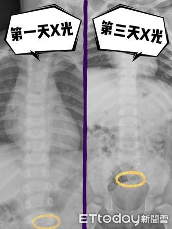 【你的育儿经】1岁童久咳不止　竟有针在腹险穿孔
