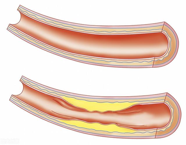 心脑血管病的祸根“低密度脂蛋白胆固醇”，做到这几点就能控制