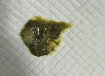 「暖先生格调」宝宝拉绿便就是奶粉的“锅”？饥饿、辅食......这些都可能，附图干货拿去！