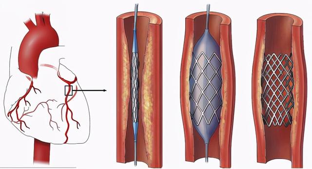从1.3万元降到700元，这样的心脏支架还能救人吗？