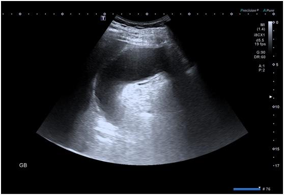 超声|胆囊炎急性发作却不能手术怎么办？这个方法为他赢得手术机会