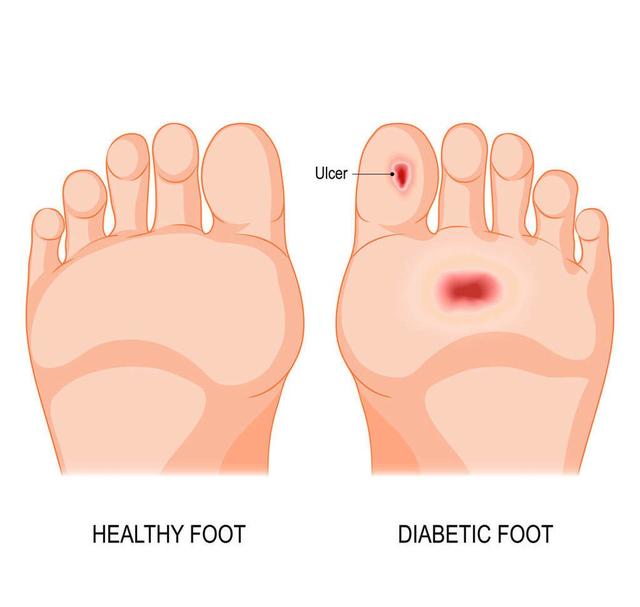「并发症」冬季糖尿病友易并发糖尿病足，糖友该如何预防