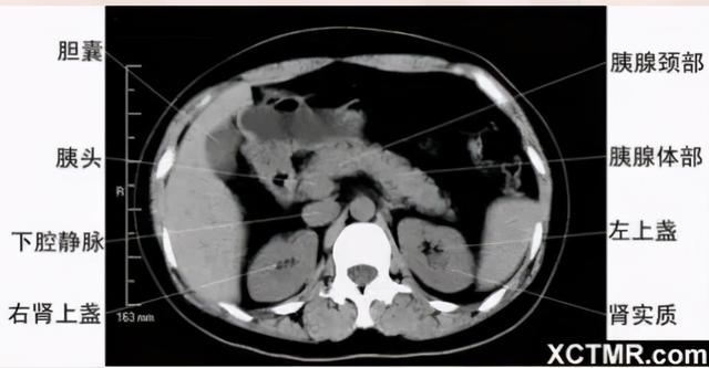 影像解剖：胸、腹部、盆腔CT解剖