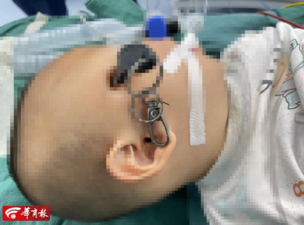 钥匙|太惊险！摩托车钥匙插入2岁男童太阳穴！当时孩子正在……