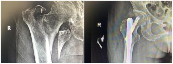 骨折|94岁老人遭遇“死亡骨折”，南京市江宁医院骨科微创手术显神功