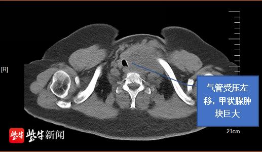 肿块|直径10厘米，如“大橙子”！苏大附二院甲乳外科成功为患者切除胸骨后巨大甲状腺肿块