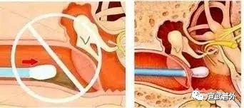 你的耳朵其实不需要“挠痒痒”