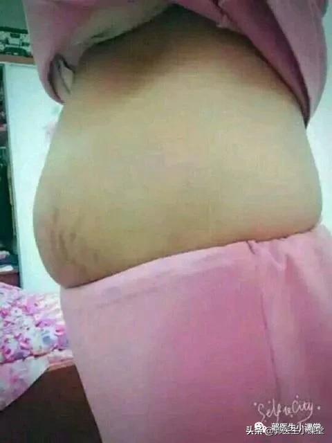 「超级宝妈」生完孩子还有个大肚子,怎么办?