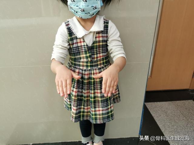 「超级宝妈」小孩骨折一定要防止漏诊（陈旧性孟氏骨折）