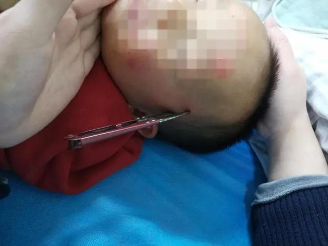 你的育儿经■揪心！剪刀突然插进阜阳2岁男孩头颅！家长切记！