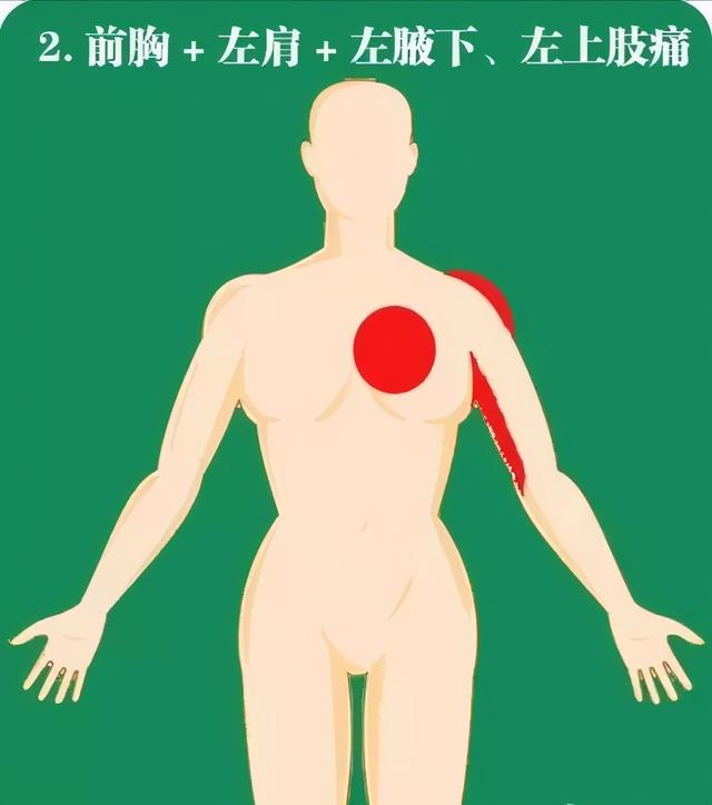 急性心梗的10个常见疼痛部位及图解