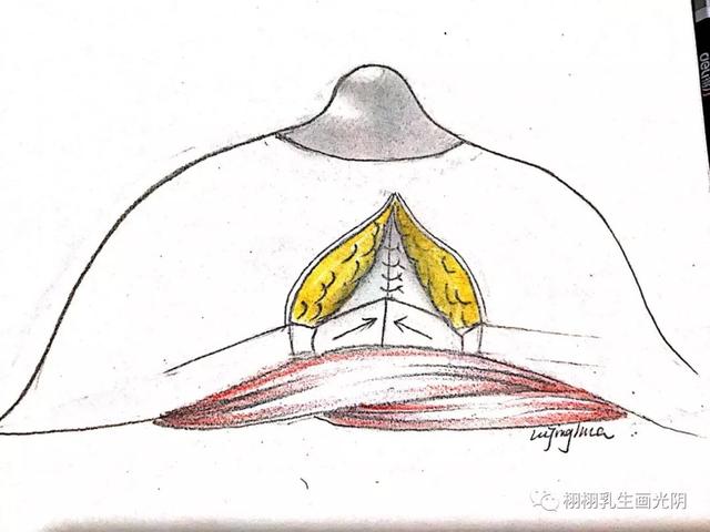 乳房疼痛与乳腺癌的关系