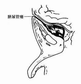 为啥不能乱抠肚脐？原来，肚脐眼连的根本就不是肠子